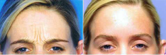 Botox before 575407
