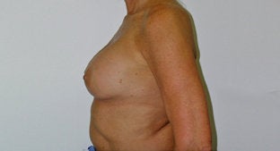 Implant Correction 494513