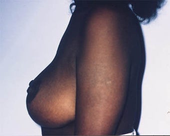 Breast Lift after 285338
