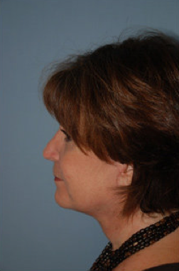 Neck Lift after 265847