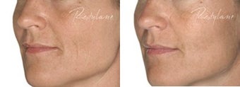 Before and after Restylane on fine lines before 6270
