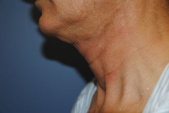 Ultherapy - immediately before and after after 623869