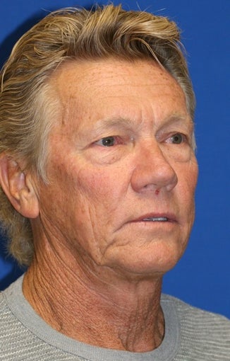 Facelift, Upper Blepharoplasty, Lower Blepharoplasty, & Lower Eyelid Skin Pinch 514805