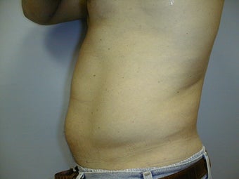Male contouring liposuction 590924