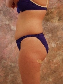 Liposuction before 140353