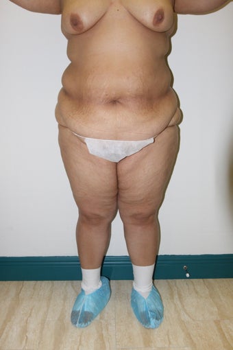 Brazilian Butt Lift 514684