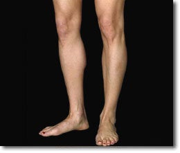 Calf Implant after 566017