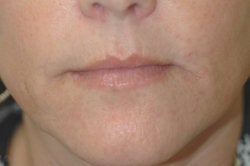 Lip enhancement (smoker's lines) before 91304