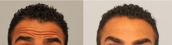 Male Botox patient before 575326