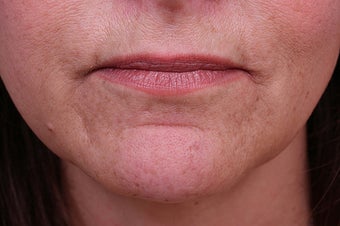 Evolence Collagen for Marionette Lines and Chin before 114168