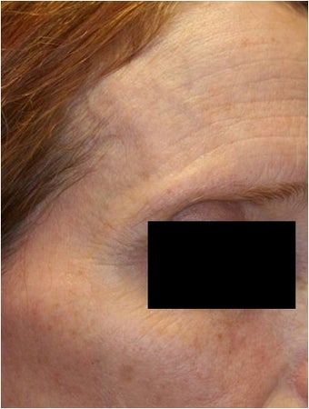 Fraxel - Photoaging before 652368