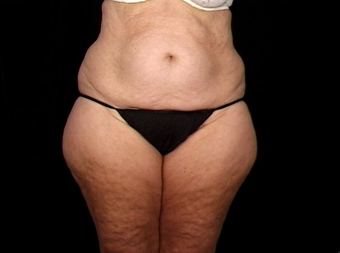 Lift of Thighs, Hips, and Butt before 230712