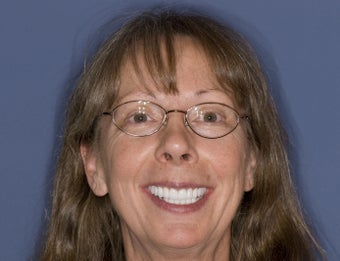 Smile Makeover after 375004