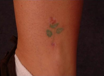QSR Ruby Laser Tattoo Removal before 329685