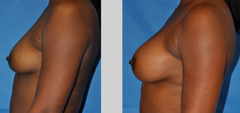 Flash Recovery Breast Augmentation TM before 253899