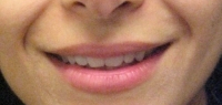 Juvederm before 272079