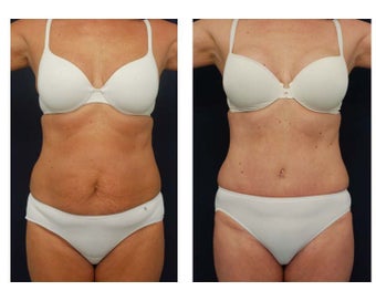 Abdominoplasty - Tummy Tuck before 396160