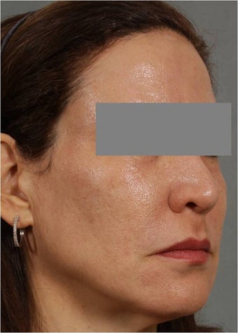 47 year old female treated for melasma, age spots, large pores and rough skin texture 645449