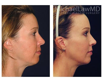 Chin Liposuction 395359