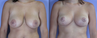 Nipple Surgery before 293281