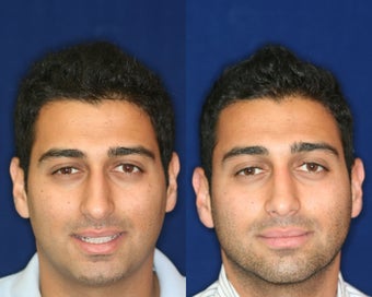 Rhinoplasty and Septoplasty before 223663
