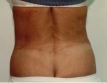 Body Contouring after 611086