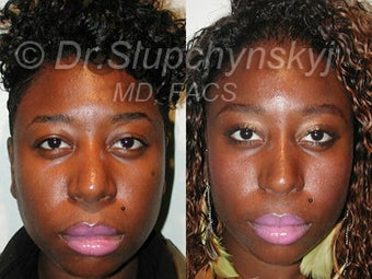 African American Rhinoplasty after 374061