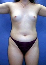 Liposculpture, Liposuction and Breast Augmentation before 151066