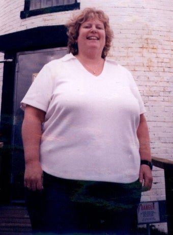 Gastric Bypass before 233098