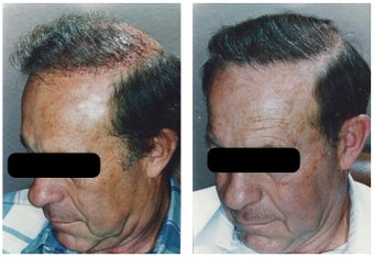 hair transplant before 369166