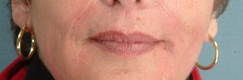 Radiesse/Juvederm after 100316