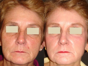 Fraxel Laser Treatment before 96254