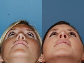 Revision rhinoplasty 436945