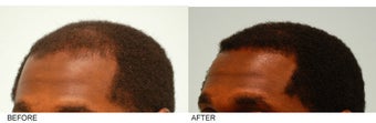 Hair Transplant after 137283