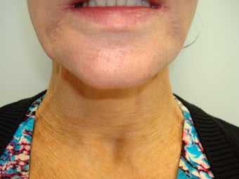 Botox after 611040