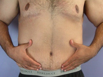 After Weight Loss after 280820