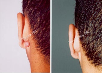Earlobe Surgery before 243324