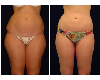 Liposuction before 286700
