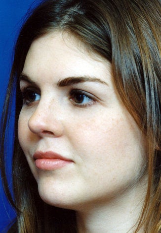 Revision Rhinoplasty after 540120