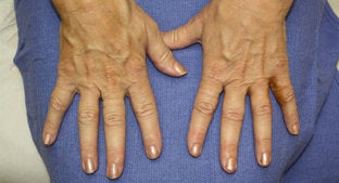 Radiesse Hands before 494484