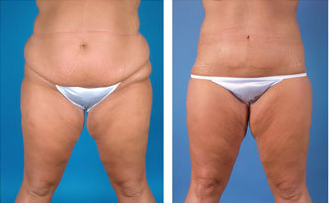 Central body lift with liposuction age 32 before 6814