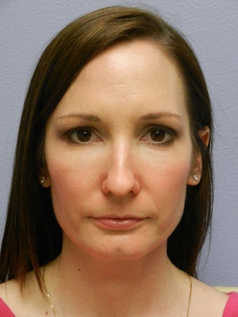 Before and After Skin Care after 635902