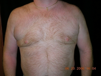 Cool Lipo after 245621