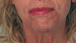 Perlane Treatment for laugh lines after 91068