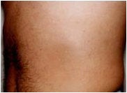 Liposuction before 205393