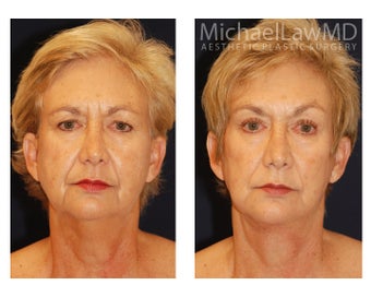 Facial Rejuvenation before 395177