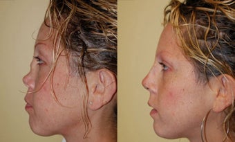 Revision Rhinoplasty Nose Surgery before 368726