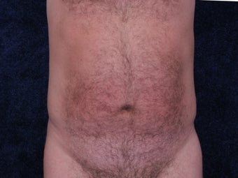 Liposuction to the waist and hips. after 396363