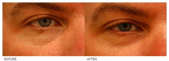 Mole Removal before 138531