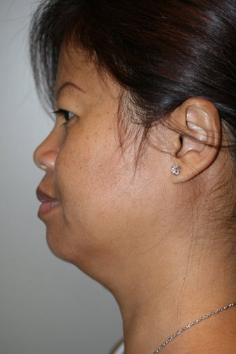 SmartLipo to the neck before 526866
